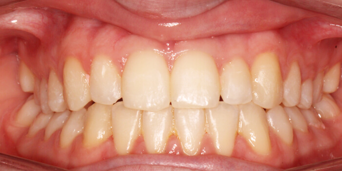 Greenacre Orthodontics Smile Gallery AL After