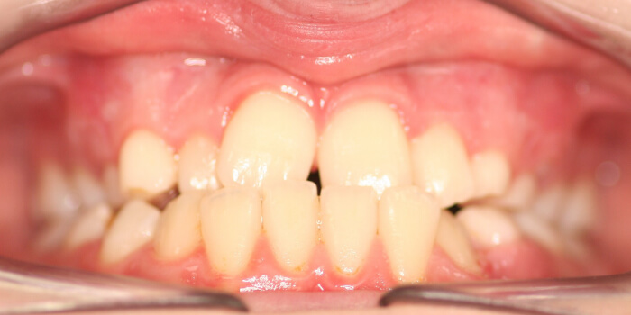 Greenacre Orthodontics Smile Gallery AL Before