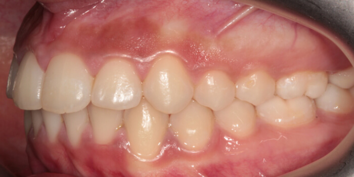 Greenacre Orthodontics Smile Gallery AS 1 After