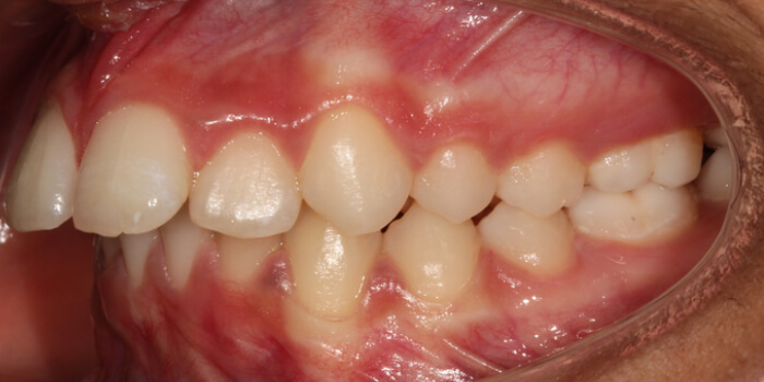 Greenacre Orthodontics Smile Gallery AS 1 Before