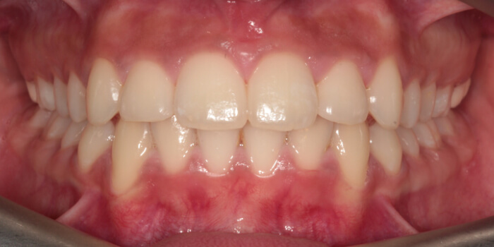 Greenacre Orthodontics Smile Gallery AS 2 After
