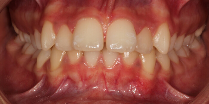 Greenacre Orthodontics Smile Gallery AS 2 Before