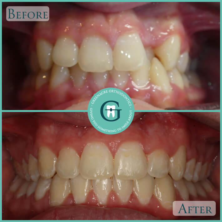 Greenacre Orthodontics Smile Gallery Before And After