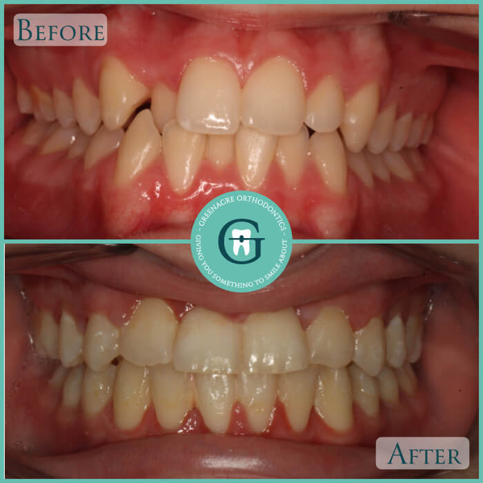 Greenacre Orthodontics Smile Gallery Before And After