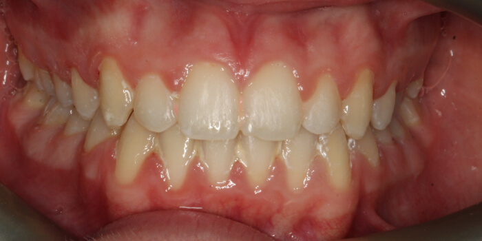 Greenacre Orthodontics Smile Gallery EH After