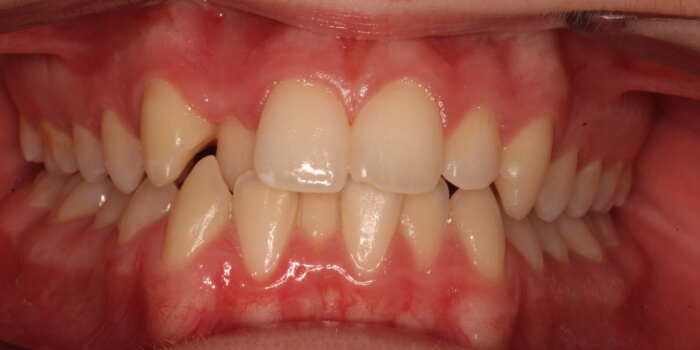 Greenacre Orthodontics Smile Gallery EH Before