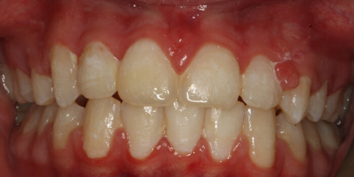Greenacre Orthodontics Smile Gallery MA After