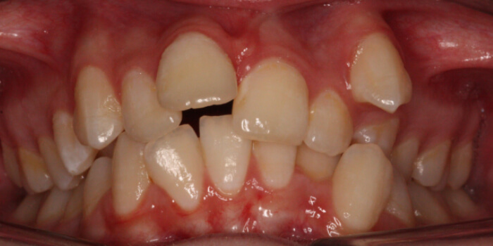 Greenacre Orthodontics Smile Gallery MA Before