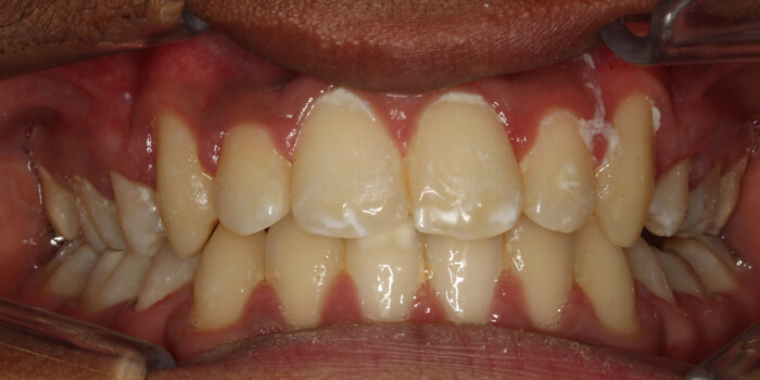 Greenacre Orthodontics Smile Gallery MH 2 After