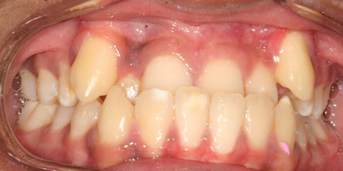 Greenacre Orthodontics Smile Gallery MH 2 Before