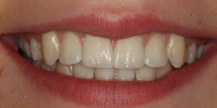 Greenacre Orthodontics Smile Gallery MI 2 After