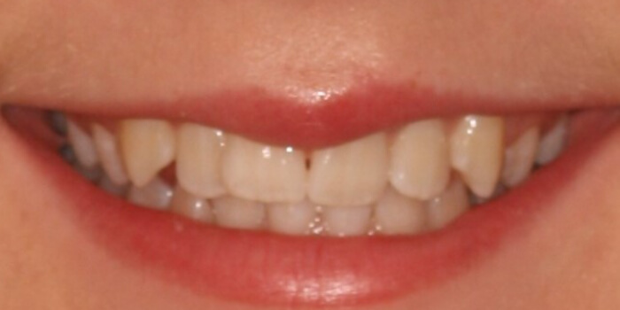 Greenacre Orthodontics Smile Gallery MI 2 Before