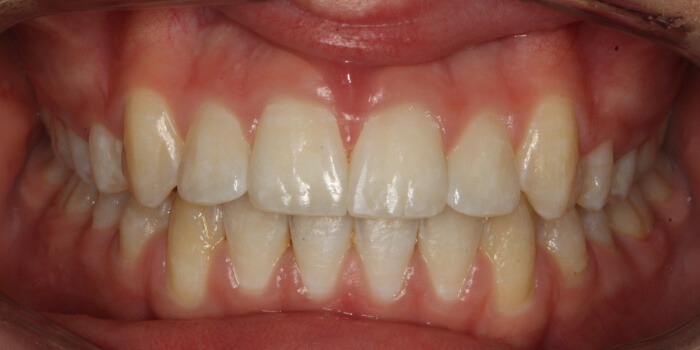 Greenacre Orthodontics Smile Gallery MI After