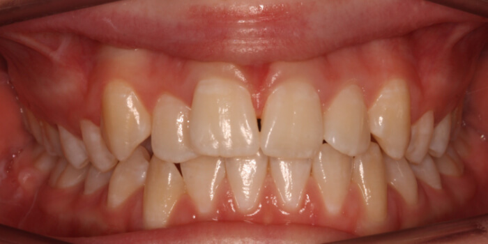Greenacre Orthodontics Smile Gallery MI Before