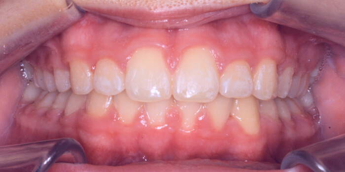 Greenacre Orthodontics Smile Gallery ML After