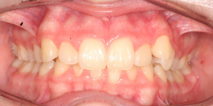 Greenacre Orthodontics Smile Gallery ML Before