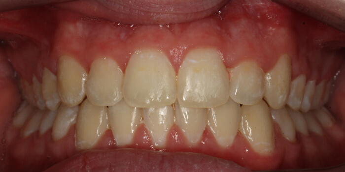 Greenacre Orthodontics Smile Gallery SB After