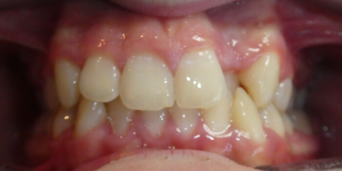 Greenacre Orthodontics Smile Gallery SB Before