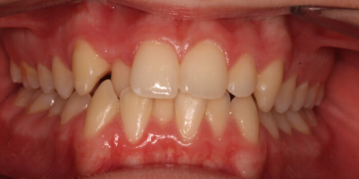 Greenacre Orthodontics Smile Gallery SL Before